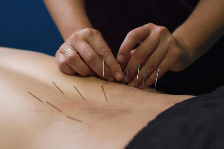 Dry needling treatment being applied to a patient
