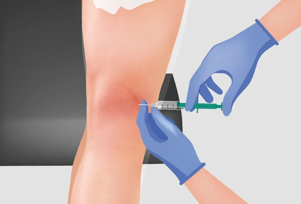 Illustration of an Arthrosamid injection being administered into the knee joint